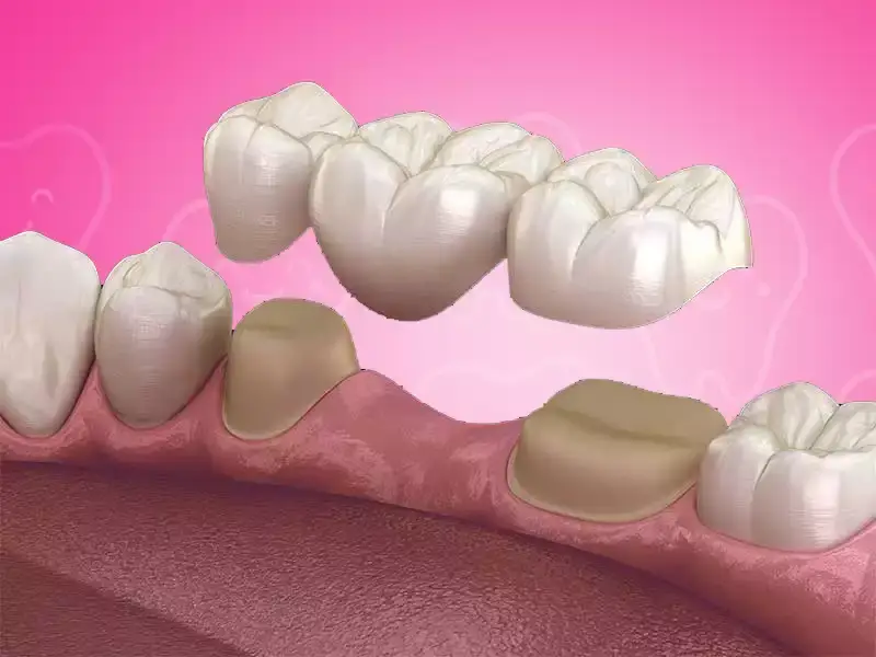 Dental Bridges