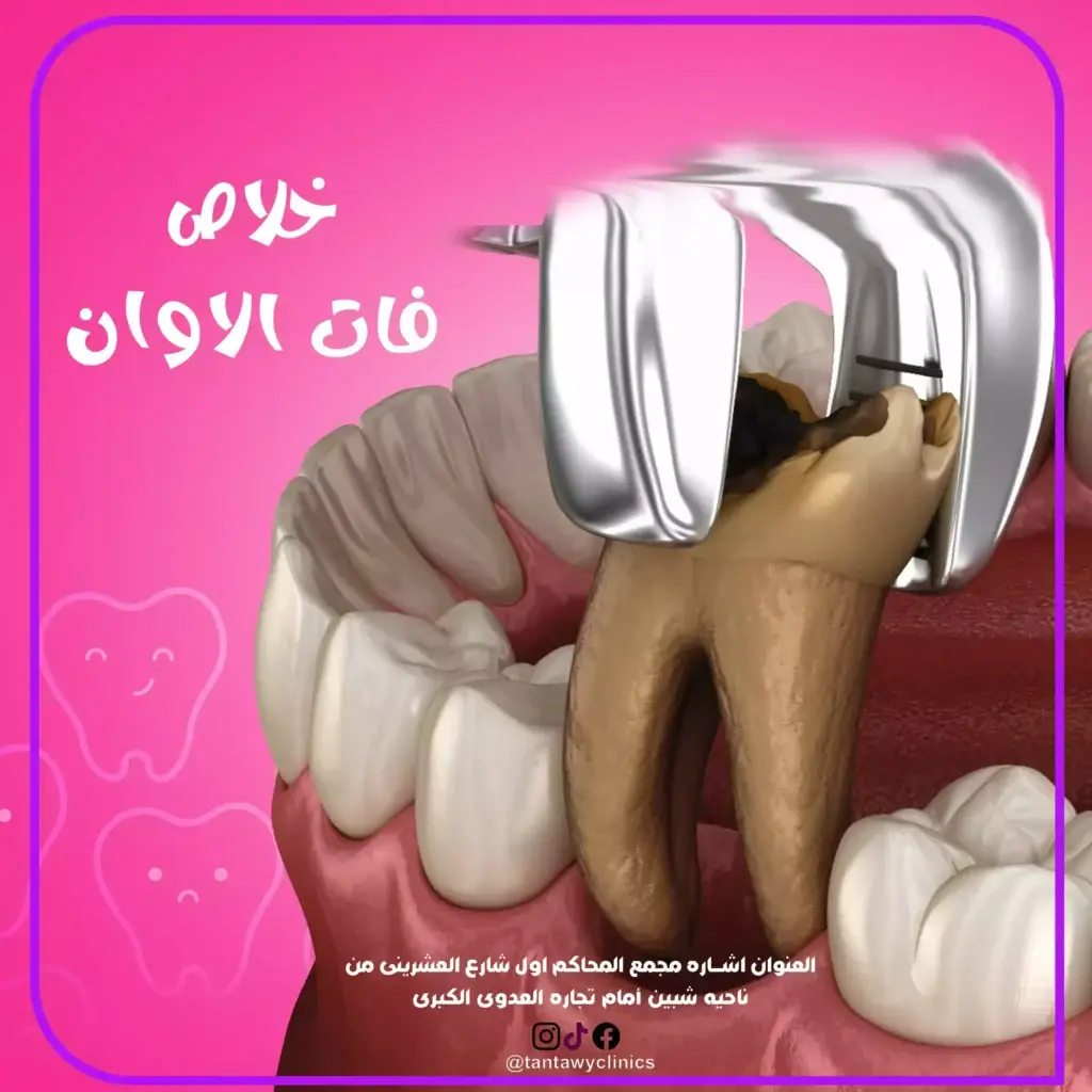 Tooth Extraction