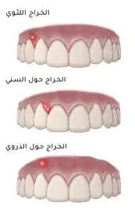 العدوى